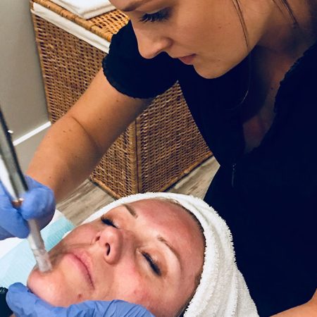 face microneedling