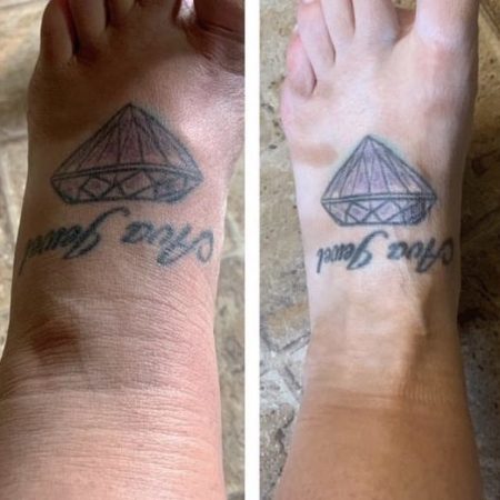 Lymphatic Drainage before & after
