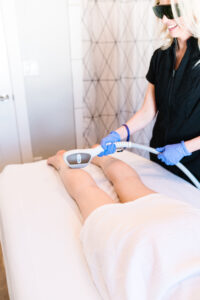 Leg laser hair removal in progress
