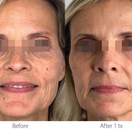 Woman before-after face treatment result