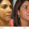 Melasma