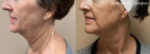 Morpheus8 treatment