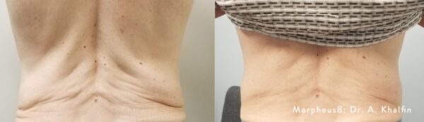 picture representing the benefits of morpheus 8 body treatment