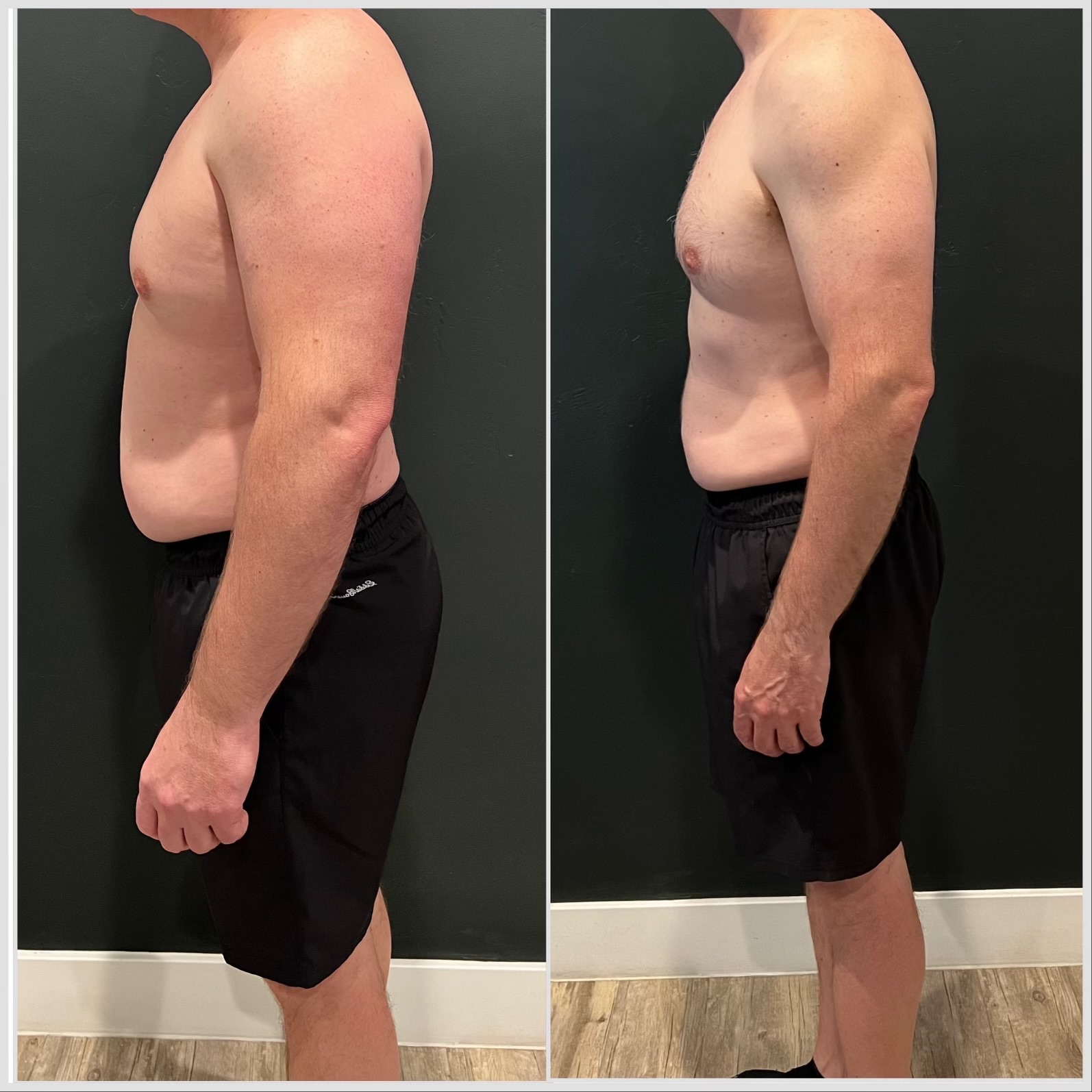 Before and after weight loss side profile