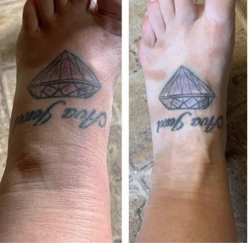 Lymphatic drainage legs before and after